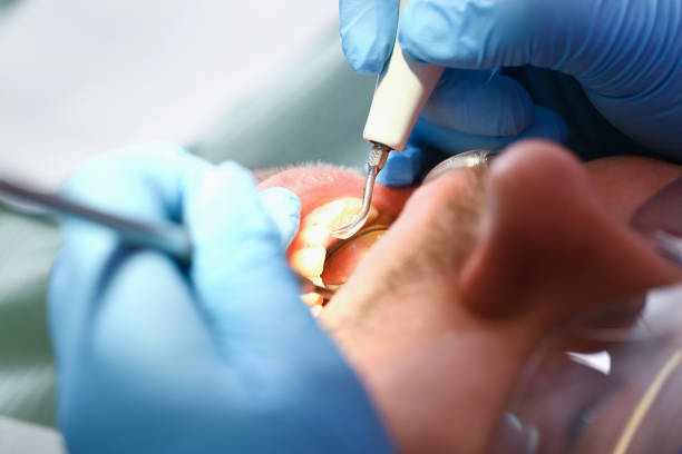 Best Dental Abscess Treatment in Rialto, CA